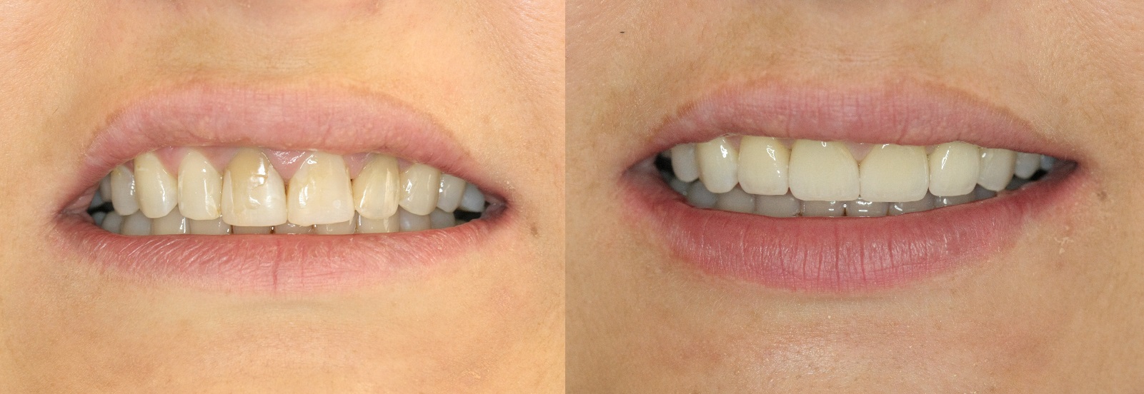 metamorfozy protetyka