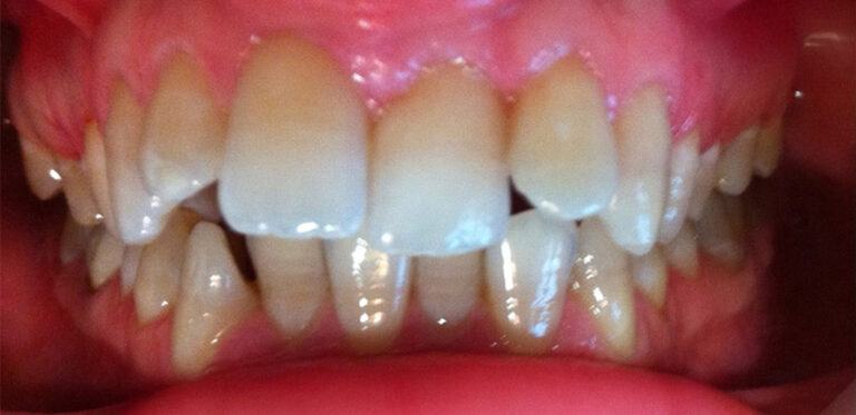 Metamorfoza 04 - przed